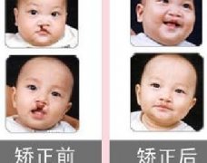 吃兔肉真的會(huì)長(zhǎng)兔唇？為什么會(huì)長(zhǎng)兔唇？